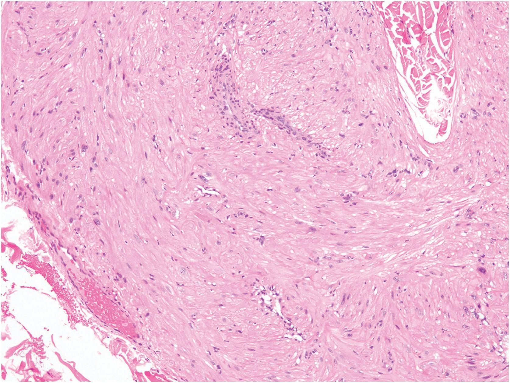 Fig. 6.7, Vascular leiomyoma (angiomyoma), composed of well-differentiated smooth muscle growing in a concentric fashion around thick-walled vessels.