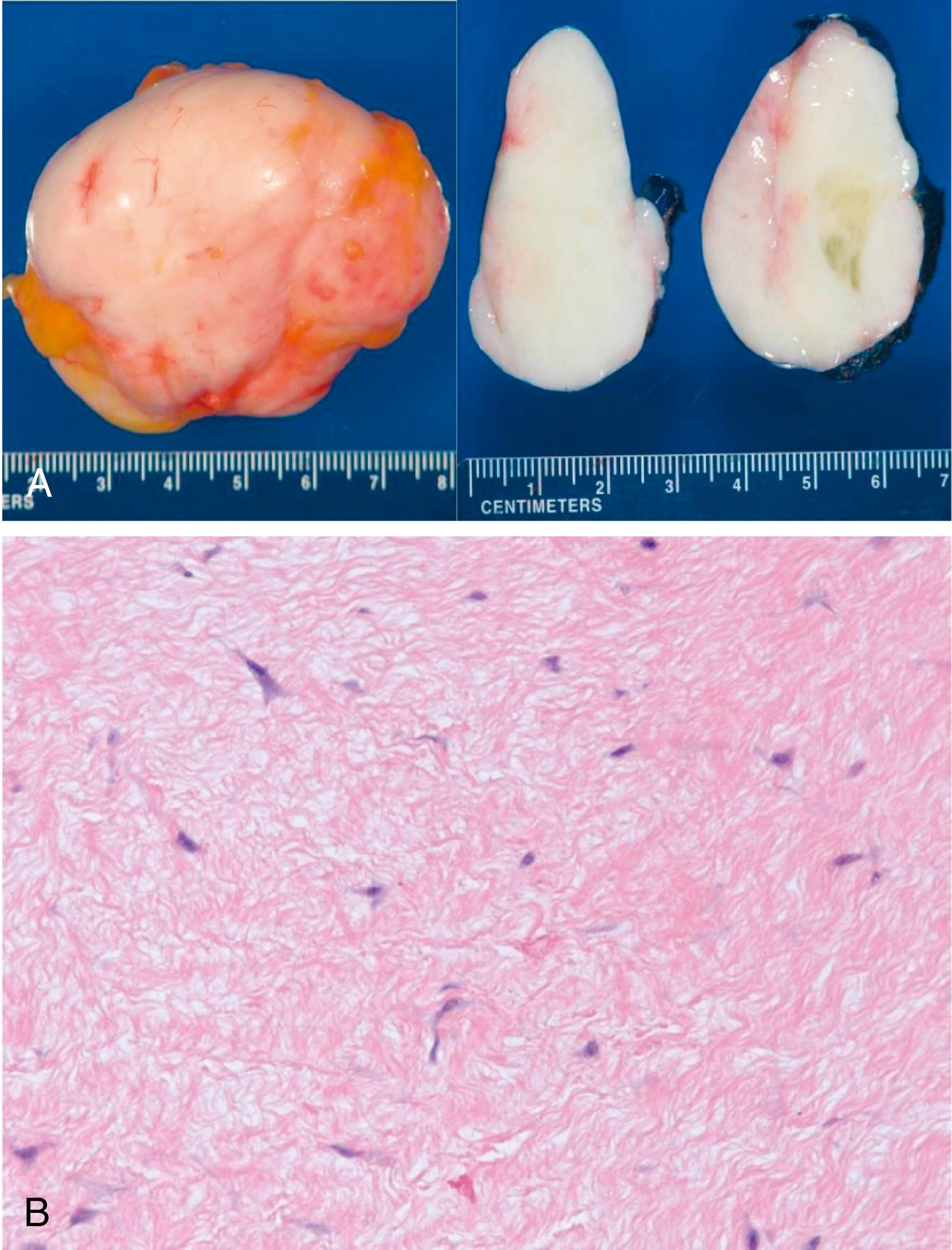 Figure 17.11, Collagenous fibroma.