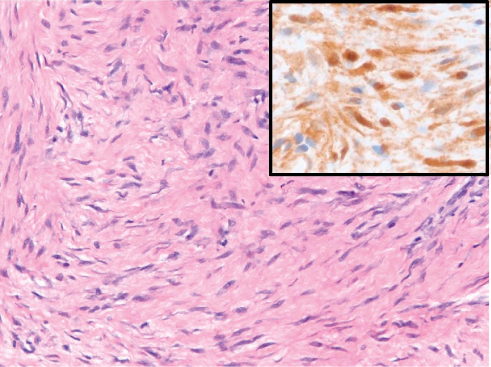 Figure 17.14, Desmoid-type fibromatosis.