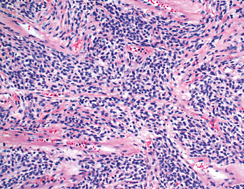 Figure 17.17, Solitary fibrous tumor.