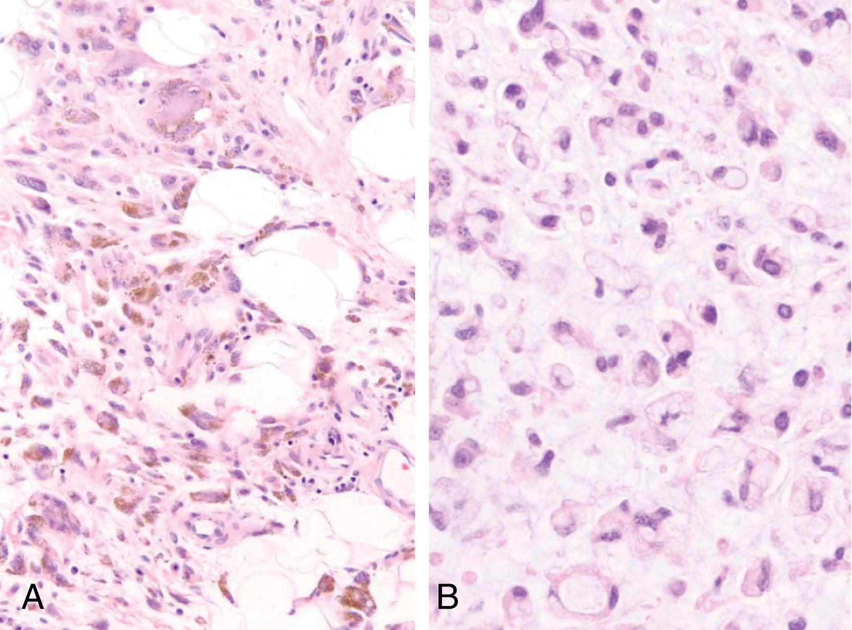 Figure 17.18, Hemosiderotic fibrolipomatous tumor/myxoinflammatory fibroblastic sarcoma; a case with mixed histology from the ankle of an adult woman.