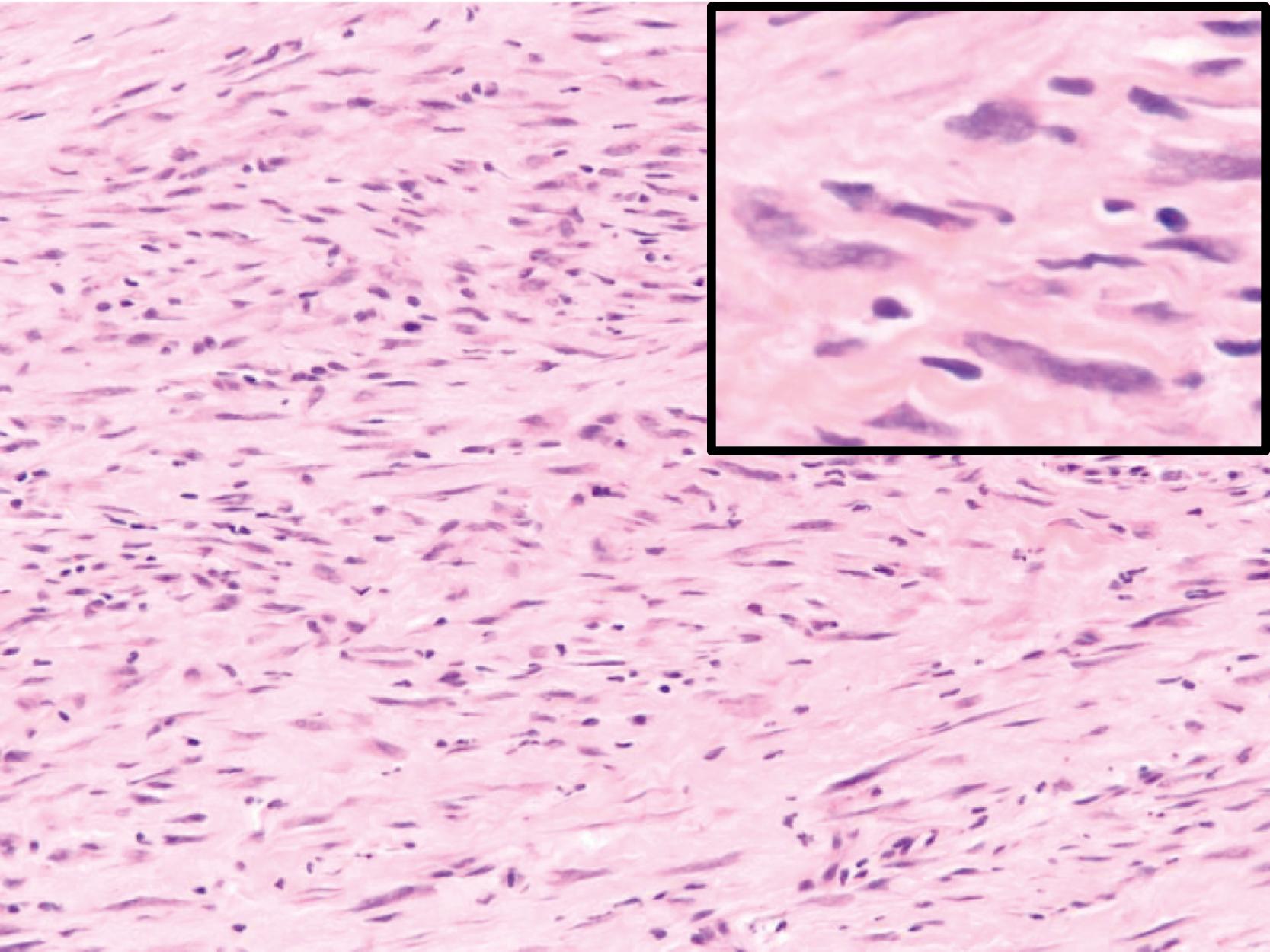 Figure 17.20, Low-grade myofibroblastic sarcoma.