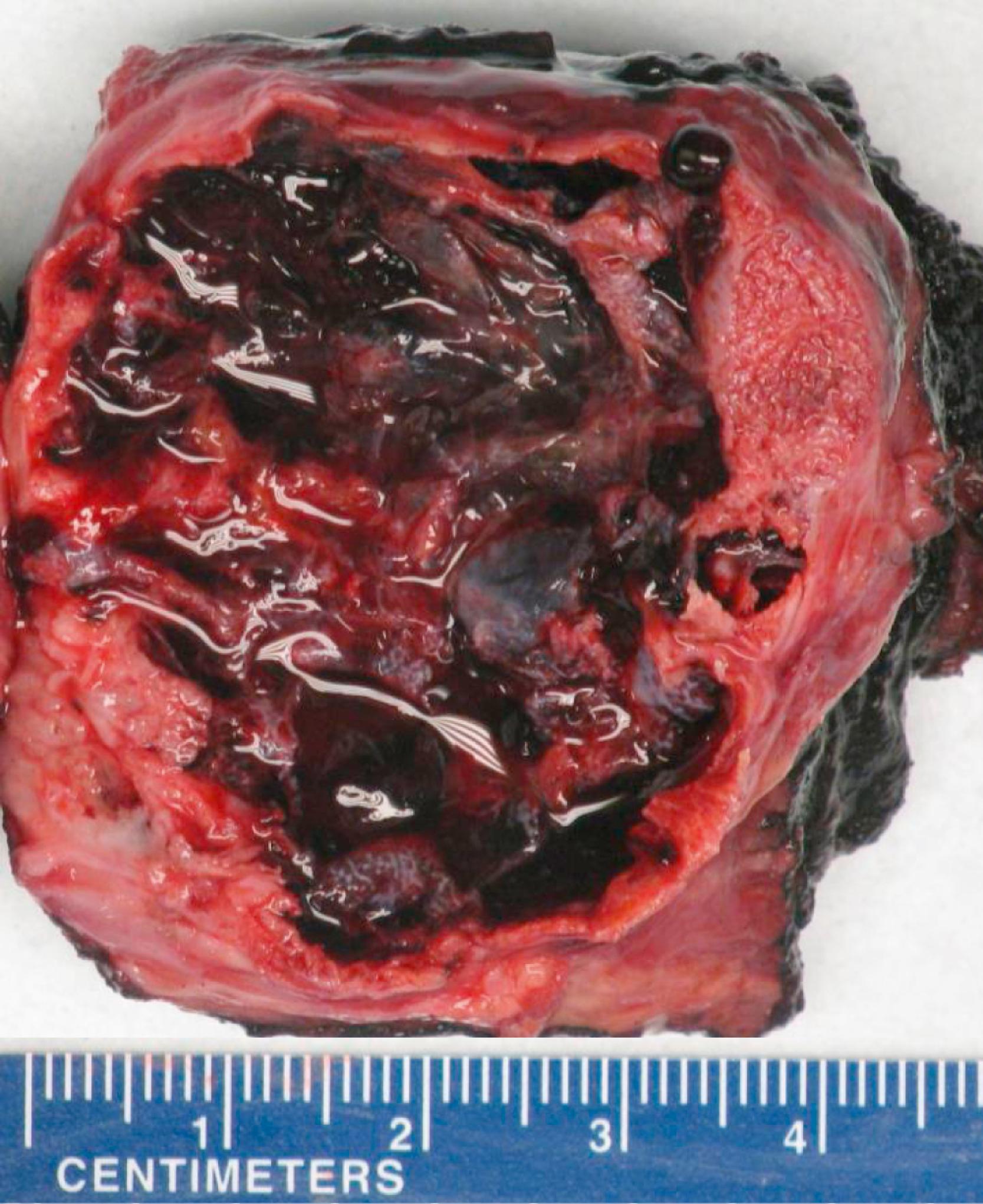 Figure 17.3, Myositis ossificans/aneurysmal bone cyst of soft tissue.