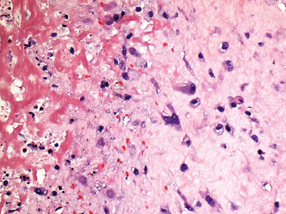 Figure 17.4, Ischemic fasciitis.