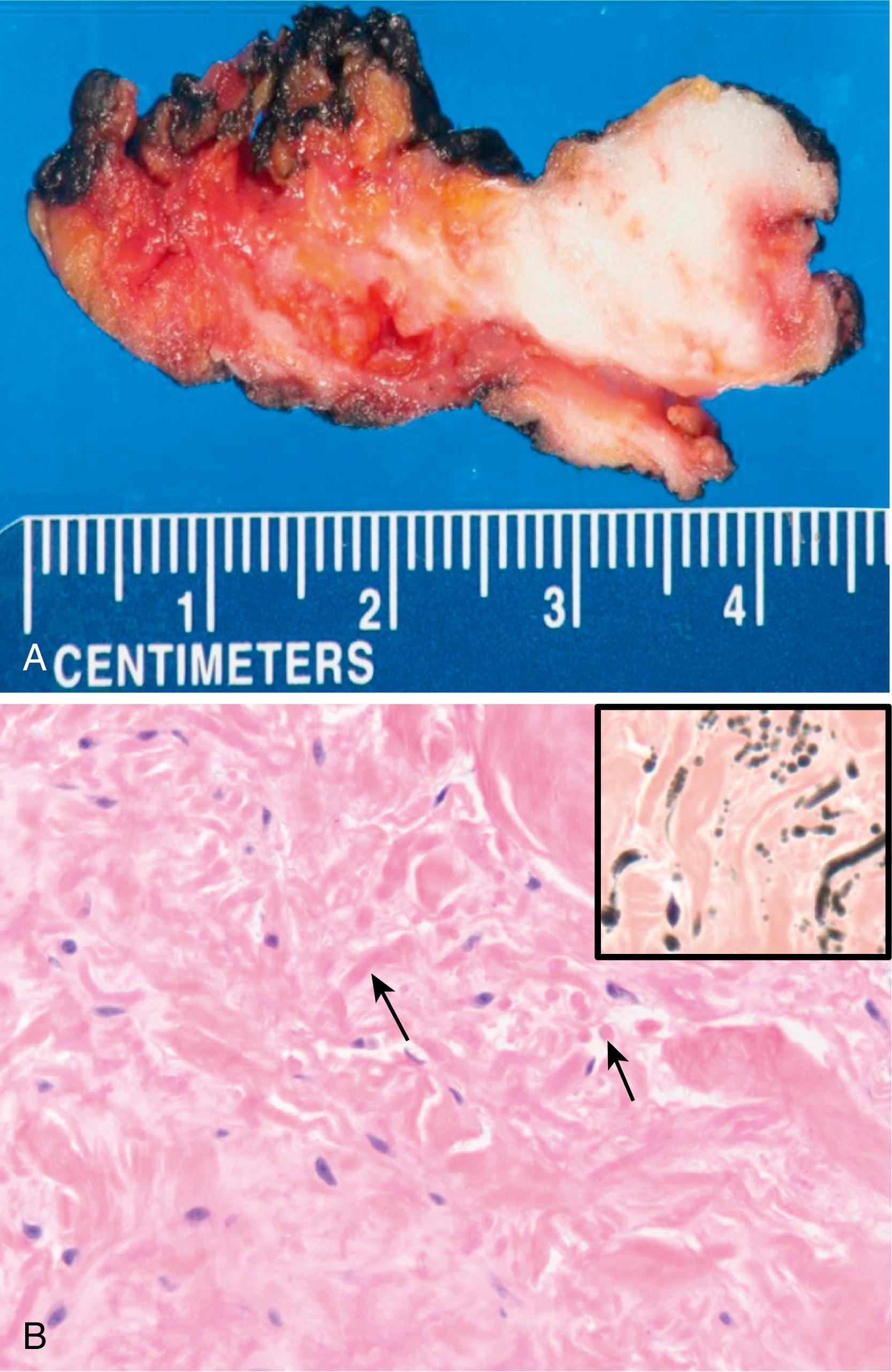 Figure 17.5, Elastofibroma.