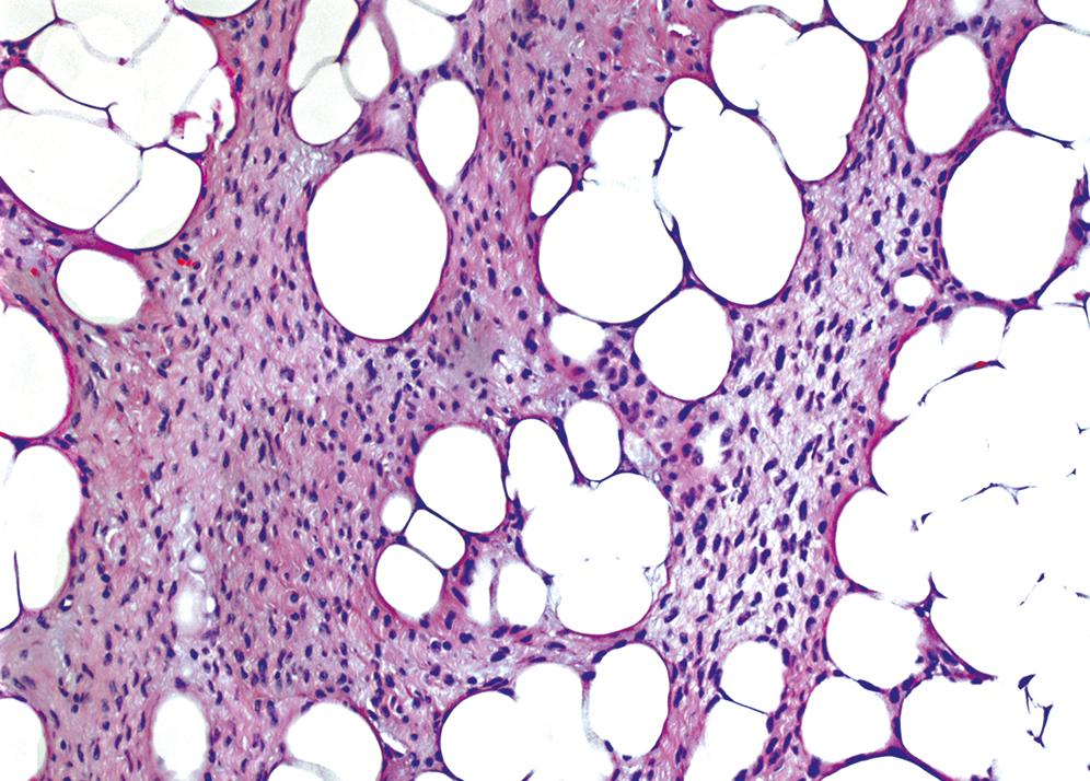 Figure 17.8, Lipofibromatosis.