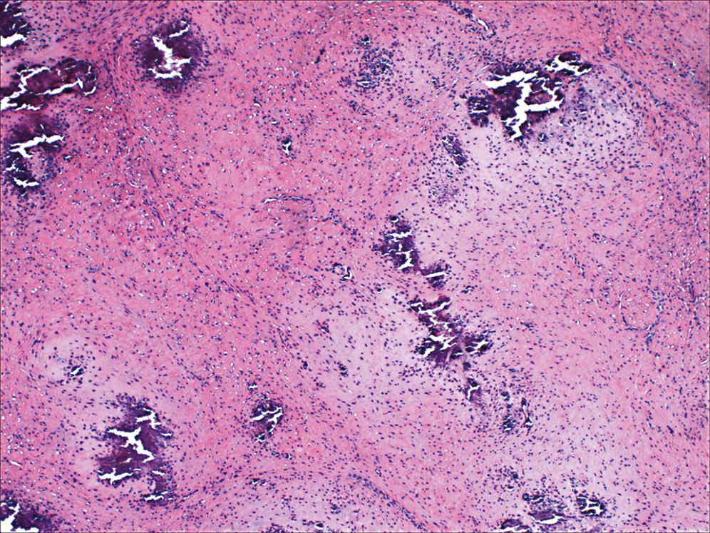 Figure 17.9, Calcifying aponeurotic fibroma.