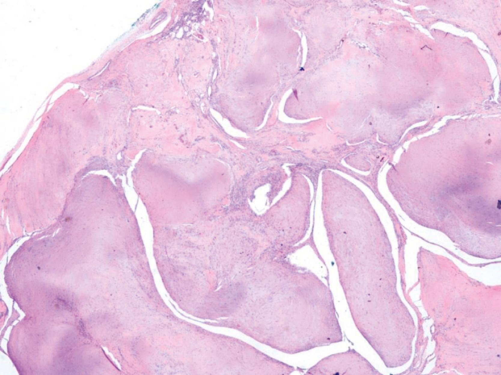 Figure 17.10, Fibroma of tendon sheath.