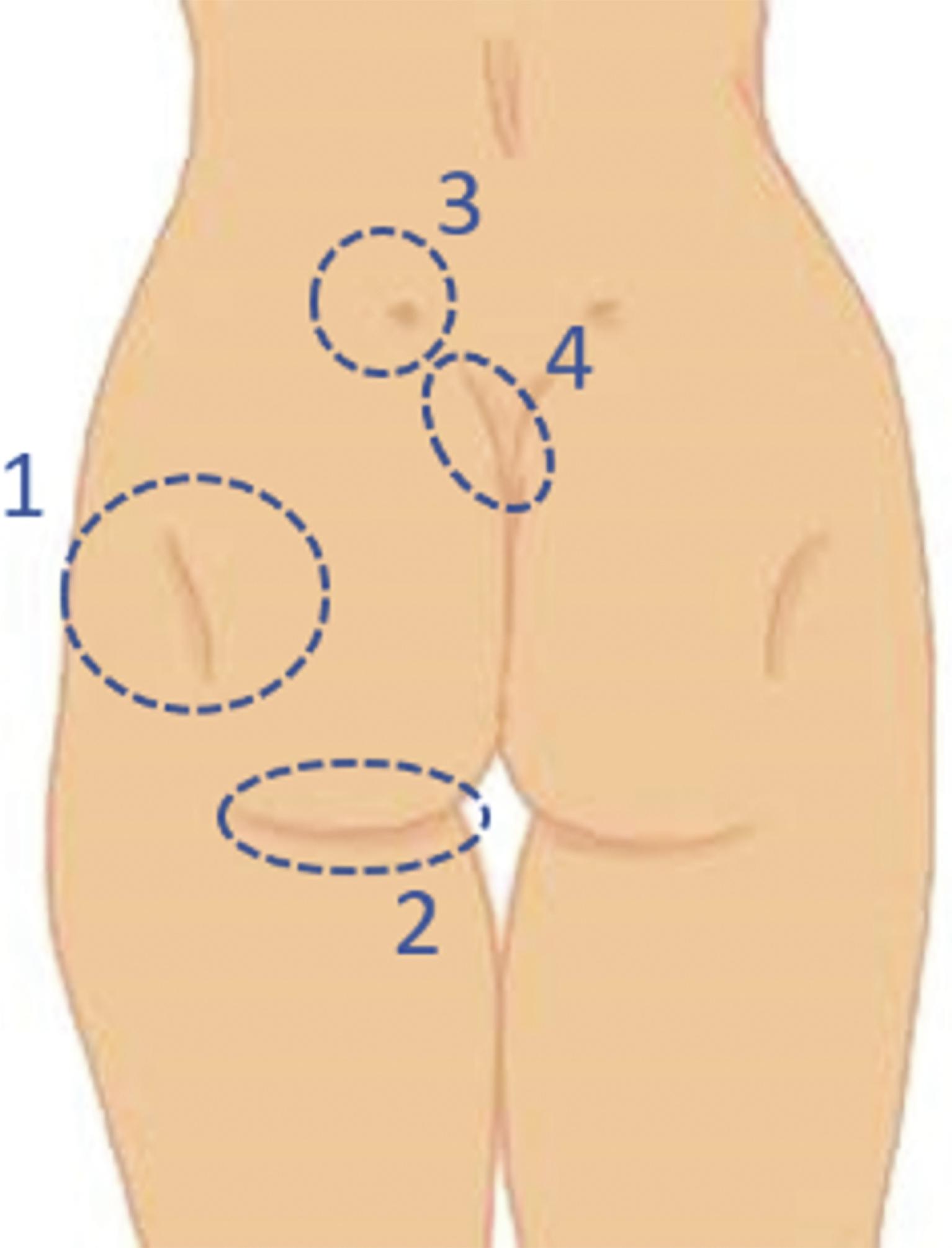Fig. 29.1, Gluteal aesthetic references: 1 , Lateral depressions; 2 , infragluteal fold; 3 , supragluteal fossettes ; 4 , V-shaped fold.