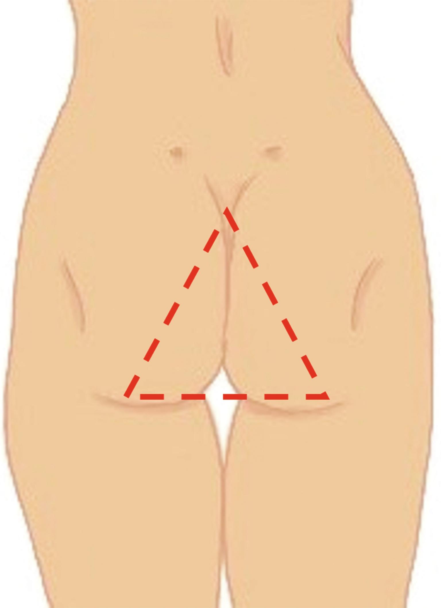 Fig. 29.2, “Danger area”: triangle with apex in the intergluteal cleft and base in the medial and lower one third of the buttocks.