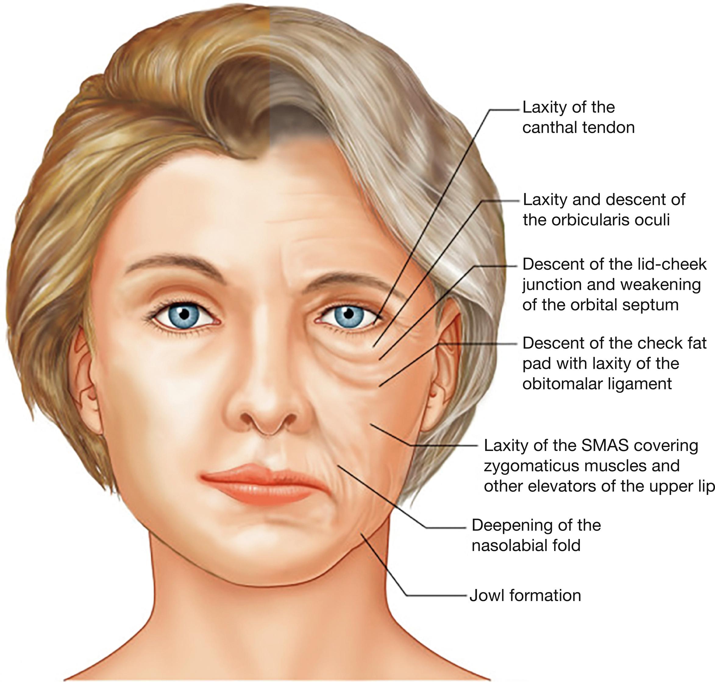 Fig. 24.1, Split-face diagram highlighting changes seen with the aging process.