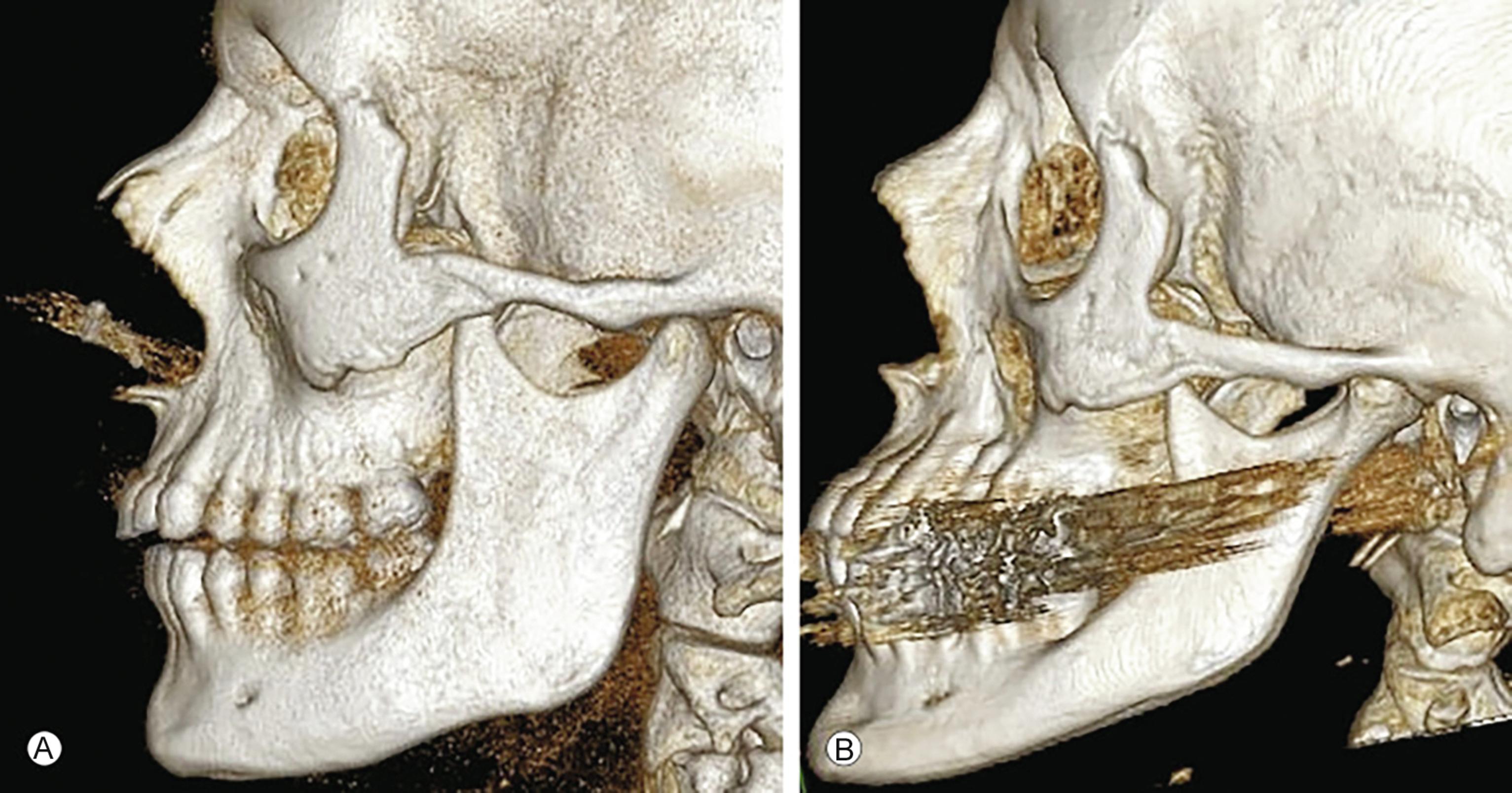 Fig. 24.2, Mandibular changes that occur with aging. (A) Young skeleton. (B) Aged skeleton.