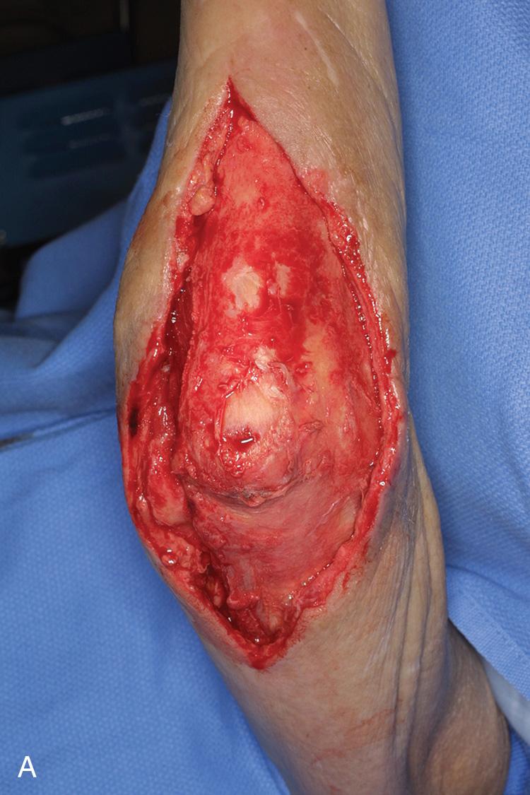 FIG 116.1, A patient presented with a rapidly spreading soft tissue infection of the elbow, developing from a chronic elbow bursitis. (A) The wound was radically débrided and then temporized with the application of a wound VAC sponge (V.A.C., KCI, San Antonio, TX) (B,C) until it was safe to proceed with definitive wound closure.