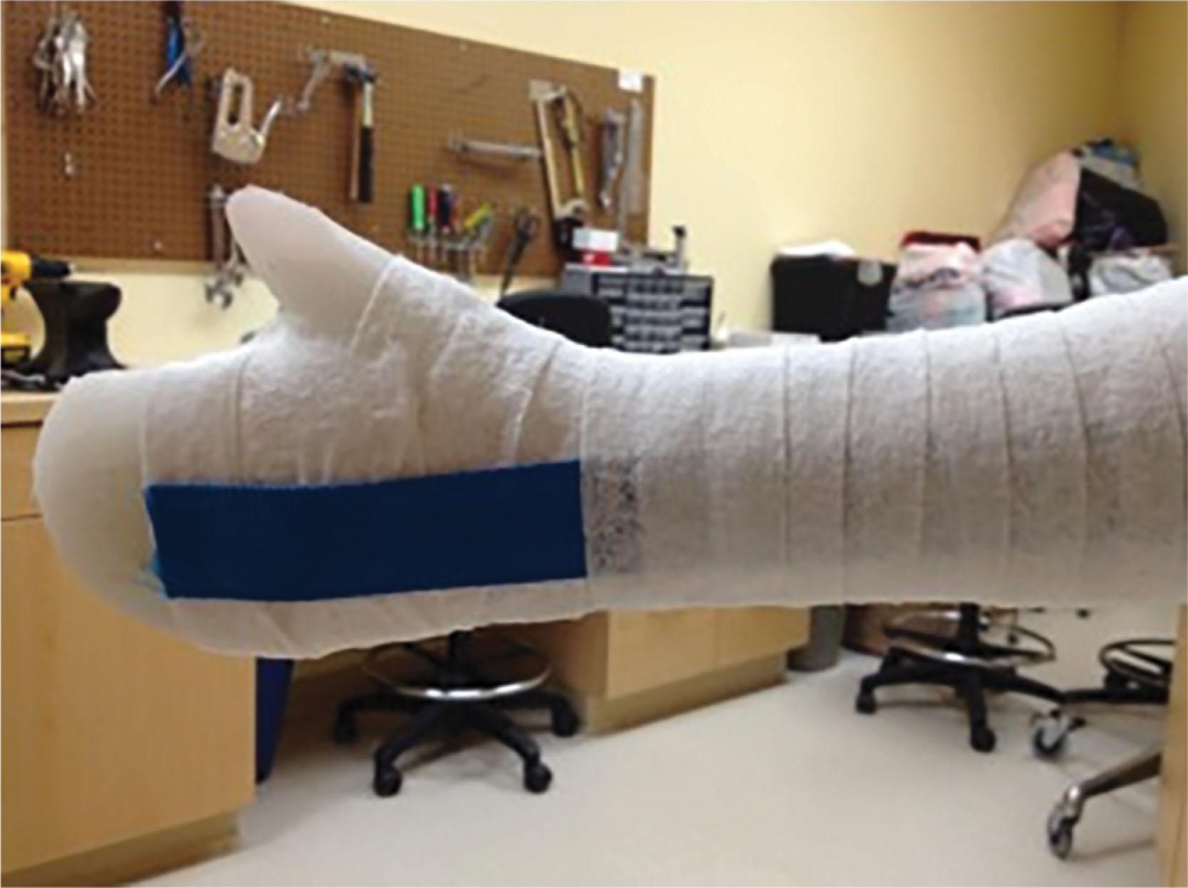 Fig. 15-11, Safety strip can be incorporated into cast to reduce the risk of cast saw injury to skin upon cast removal.