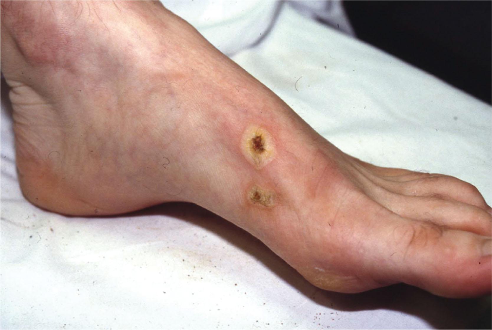 Fig. 15-12, Exit wound from electrical burn.