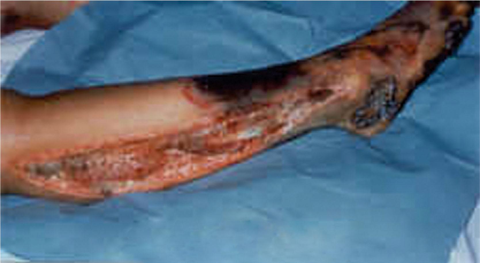 Fig. 15-14, Burn fasciotomy.