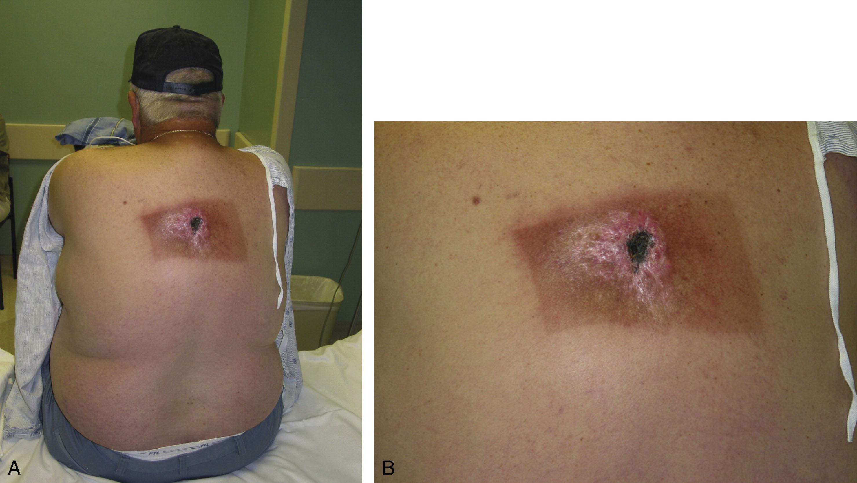 Fig. 15-18, A and B , Fluoroscopy-induced radiation dermatitis in a 58-year-old male who underwent interventional cardiology procedure for myocardial infarction. The lesion developed 7 days post-procedure and ultimately healed by secondary intent after 8 months.