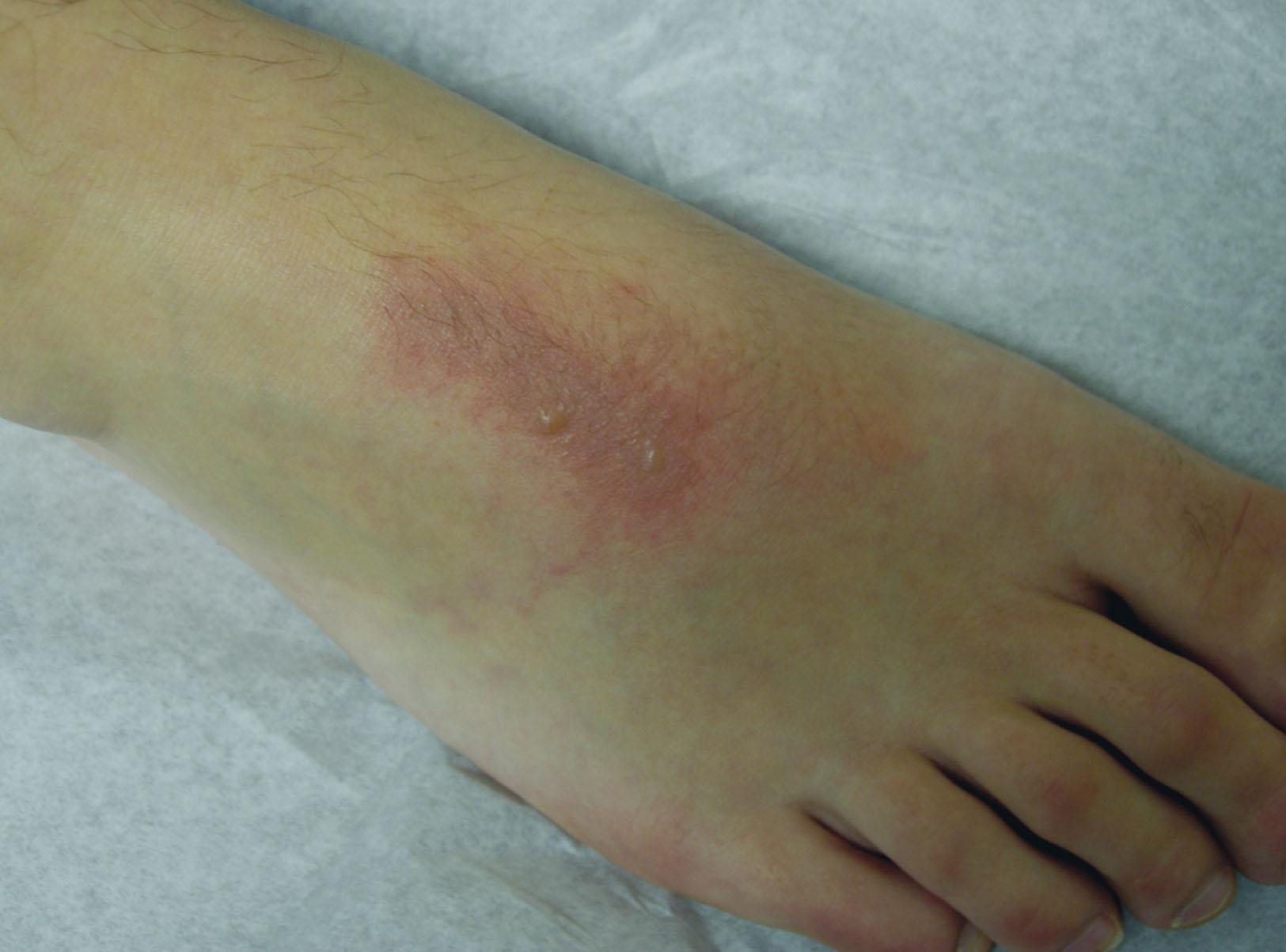 Fig. 15-2, Second-degree burn on the dorsum of the foot from an ice pack.