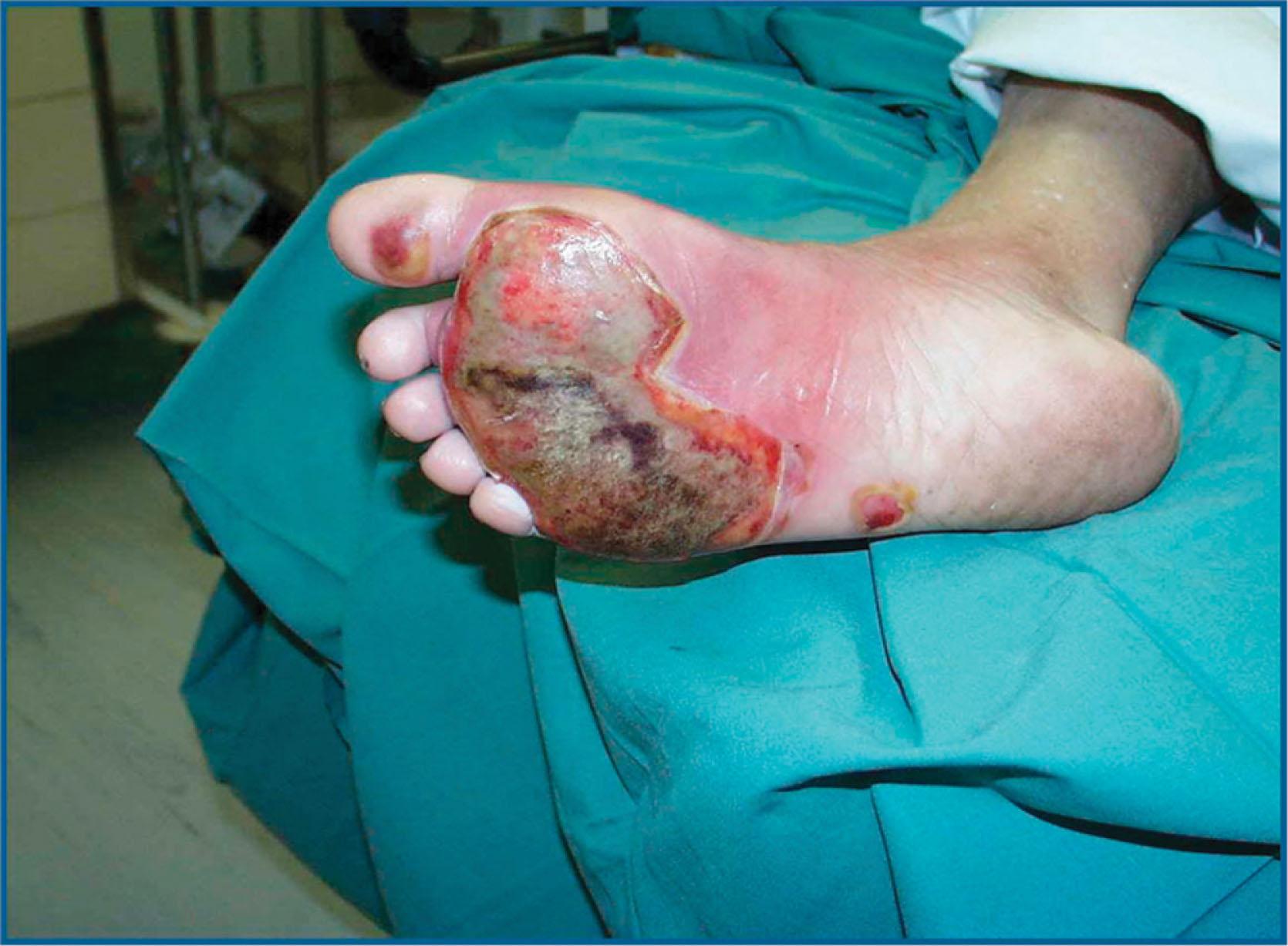 Fig. 15-3, Diabetic foot burn from standing on hot concrete.