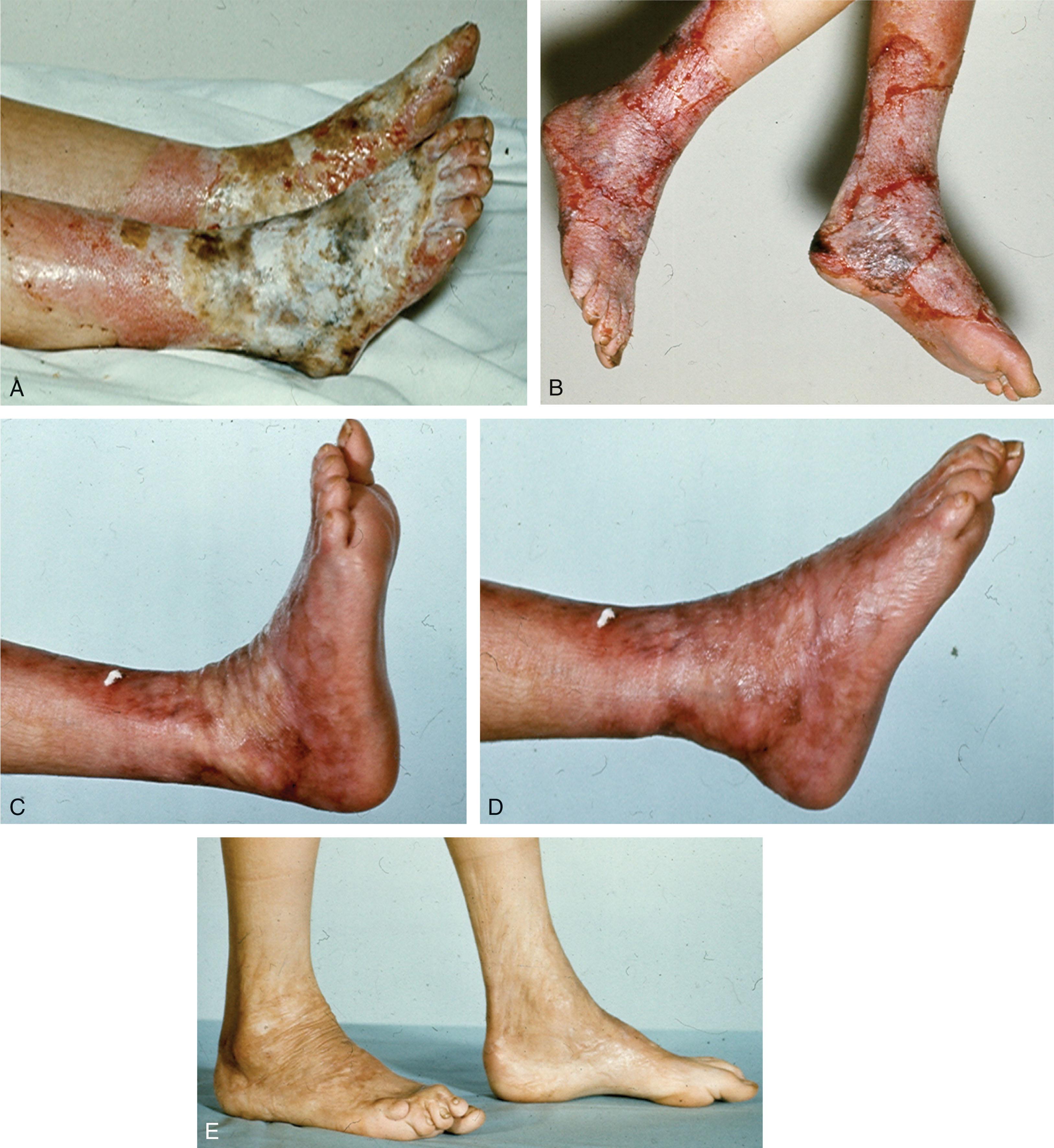 Fig. 15-4, A , 49-year-old male status post fall into a hot spring with third-degree burns to both feet and ankles. B , Healing wounds status-post skin grafting. C and D , Excellent ankle range of motion postoperatively. E , Good clinical outcome at long-term follow-up.