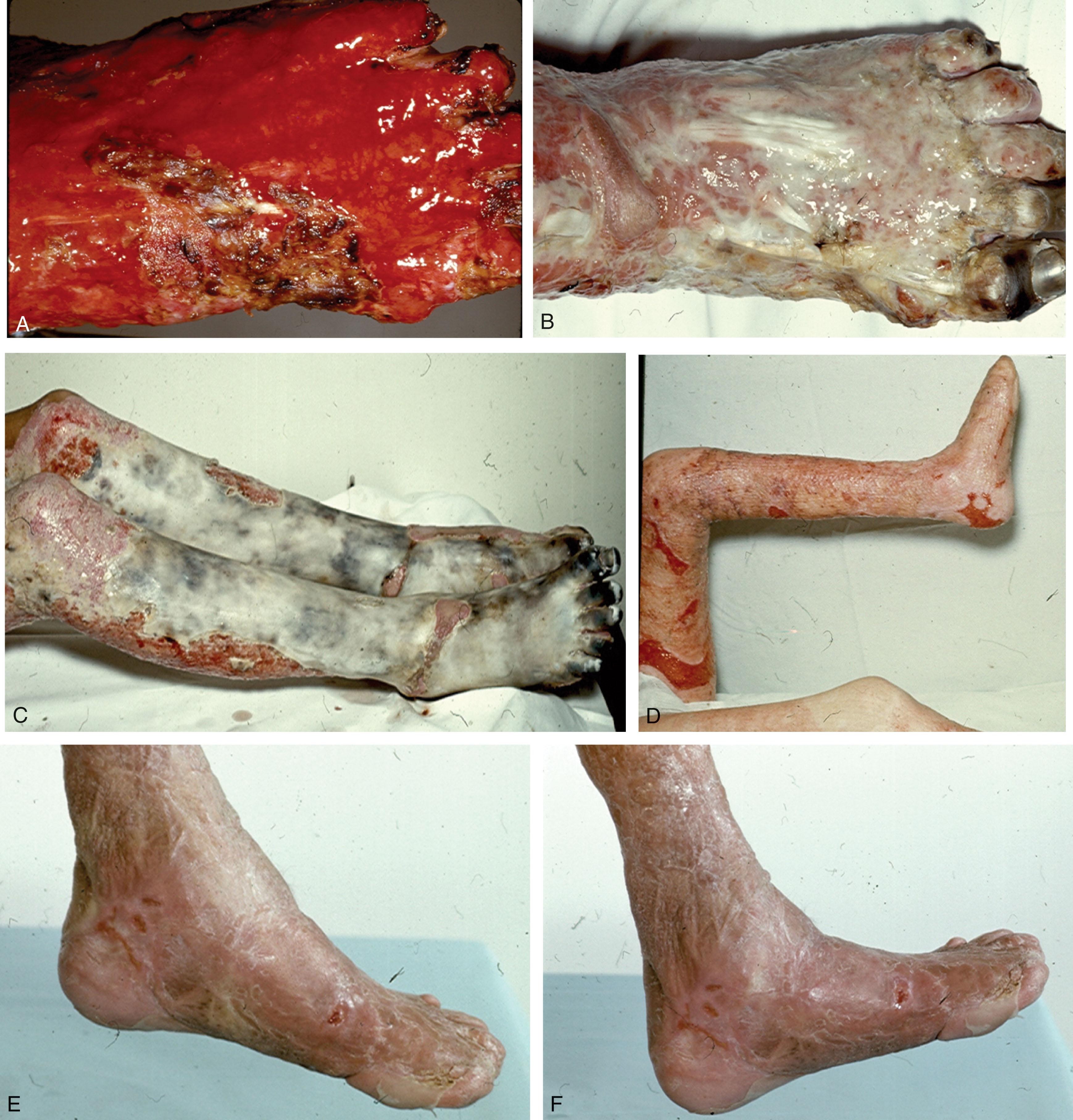 Fig. 15-5, Patient with severe thermal burns of both lower extremities. A , Acute injury. B , Two weeks after injury. C , Before debridement. D , After successful split-thickness skin grafting. Early range of motion reduces risk of contracture and results in good ( E ,) ankle plantarflexion, and ( F ) ankle dorsiflexion.