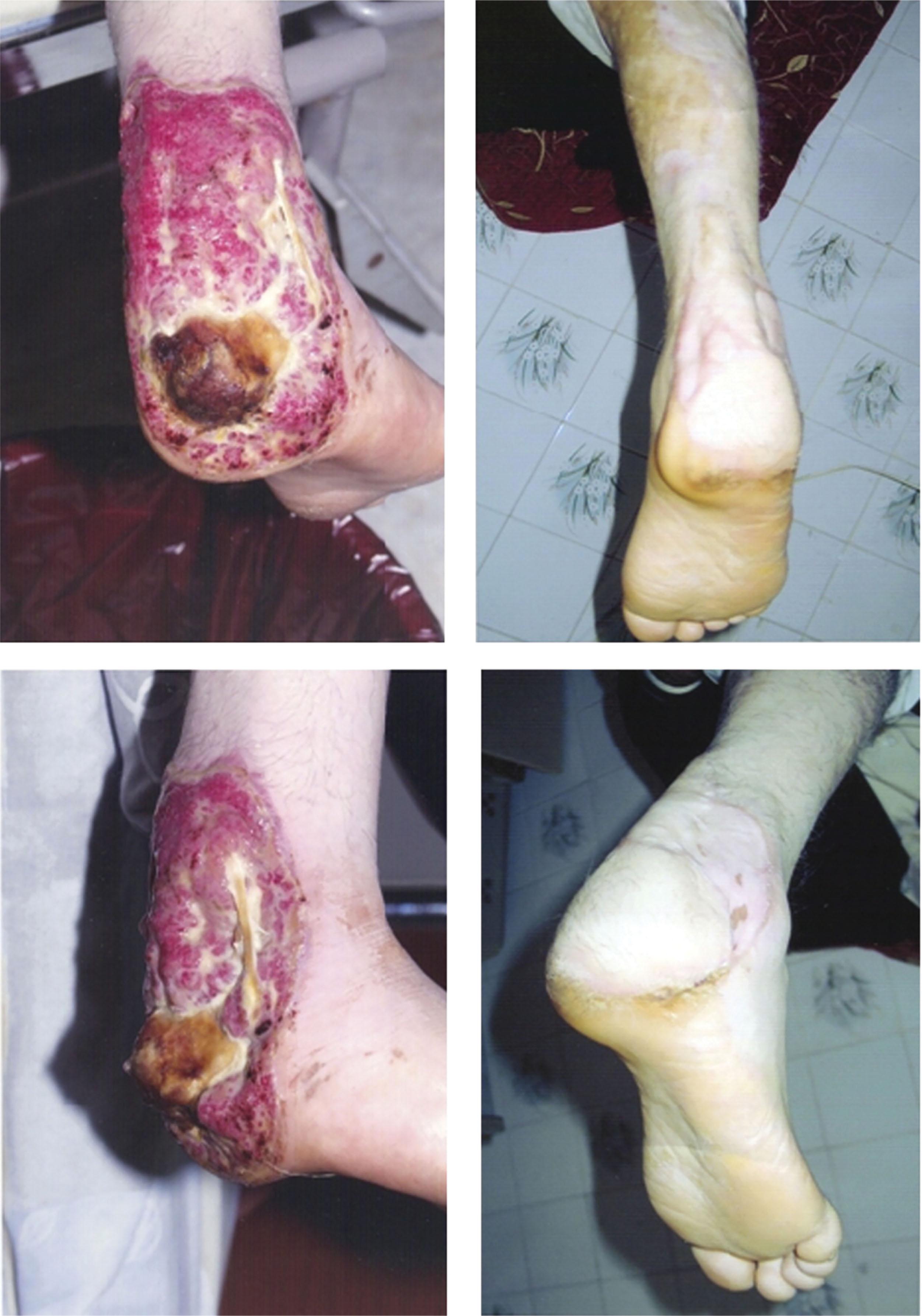 Fig. 15-6, Pre- and postoperative images of a severe burn to the posterior heel and calf that was successfully reconstructed using a neurocutaneous sural flap.