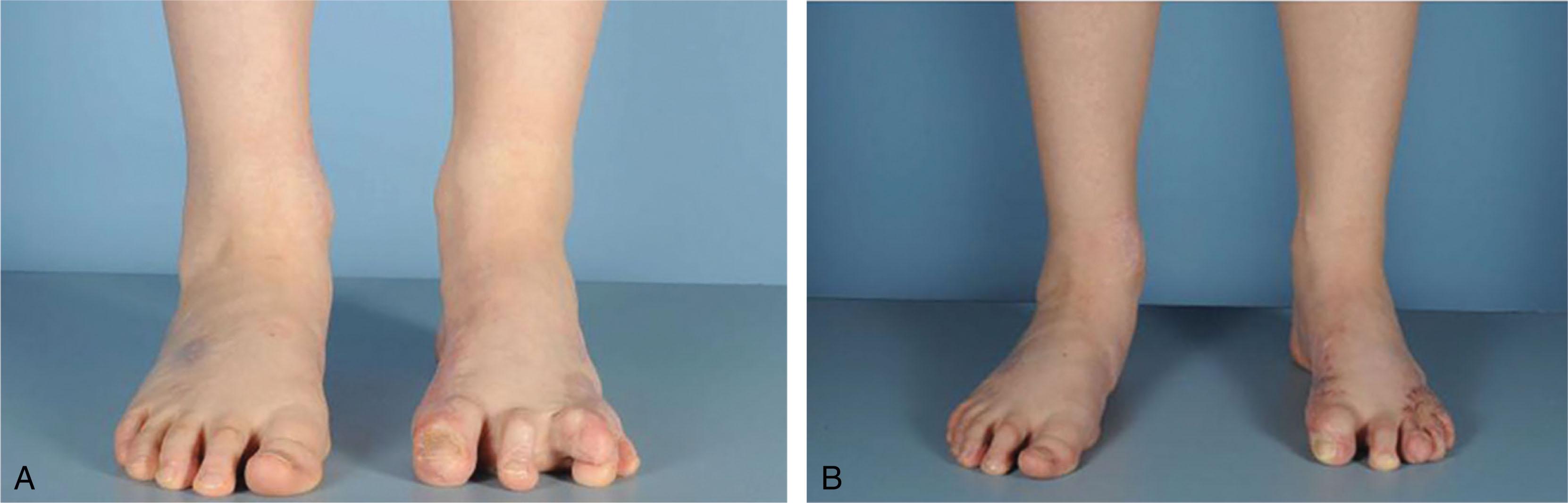 Fig. 15-7, A , Preoperative and B , postoperative clinical images of a patient with left third toe dorsal skin contracture due to prior burn injury that underwent scar excision; IP joint capsulotomy; flexor tenotomy of the third, fourth, and fifth toes; third extensor tendon lengthening; K-wire fixation; and full-thickness skin grafting.