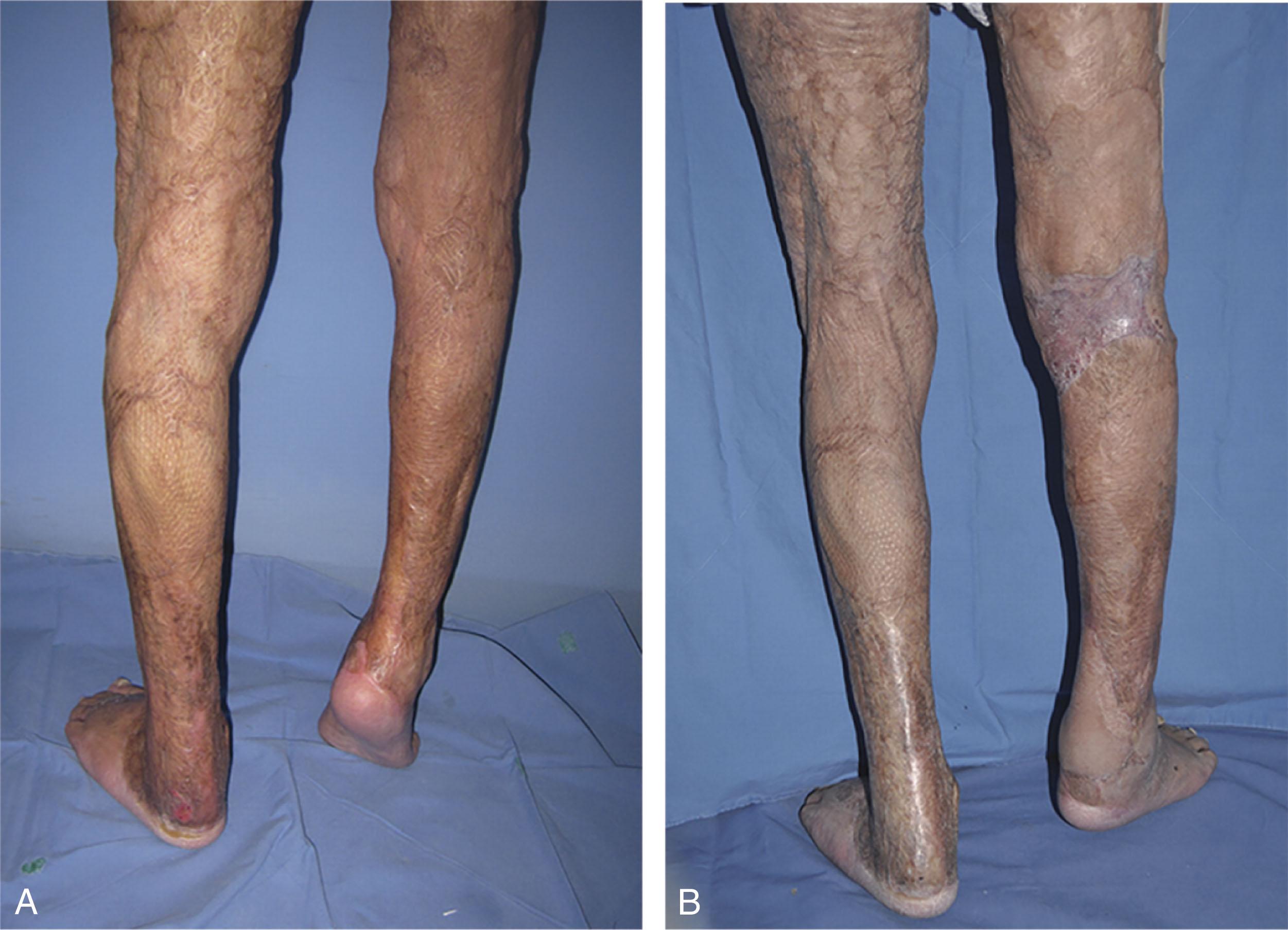 Fig. 15-8, A , Preoperative and B , 6-month postoperative images of a 37-year-old male with an equinus contracture after burn injury of the right lower extremity that underwent scar excision, Achilles tendon release, and radial forearm free flap.