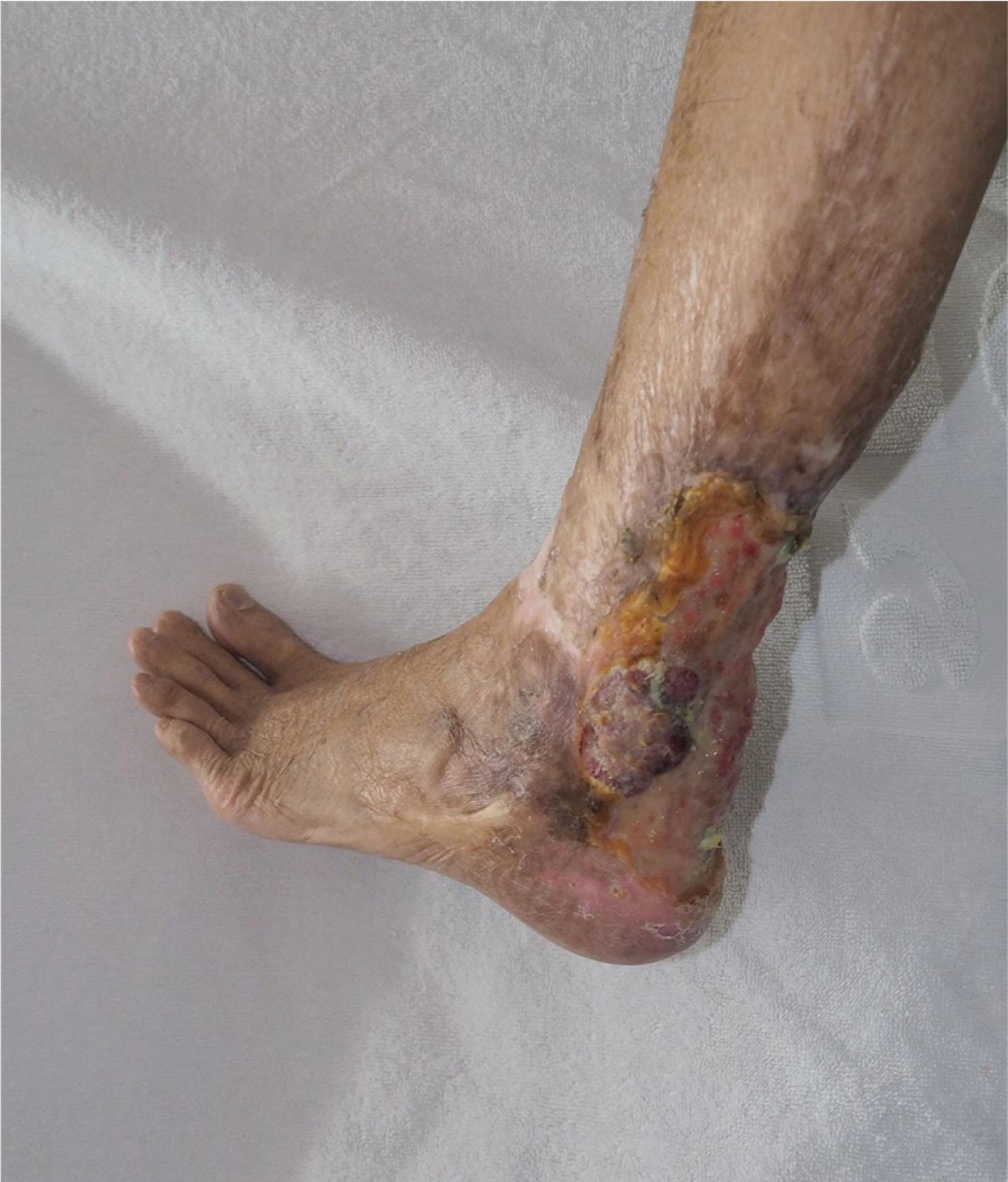 Fig. 15-9, 73-year-old male with Marjolin ulcer of the left ankle presenting more than 50 years after the original burn injury.