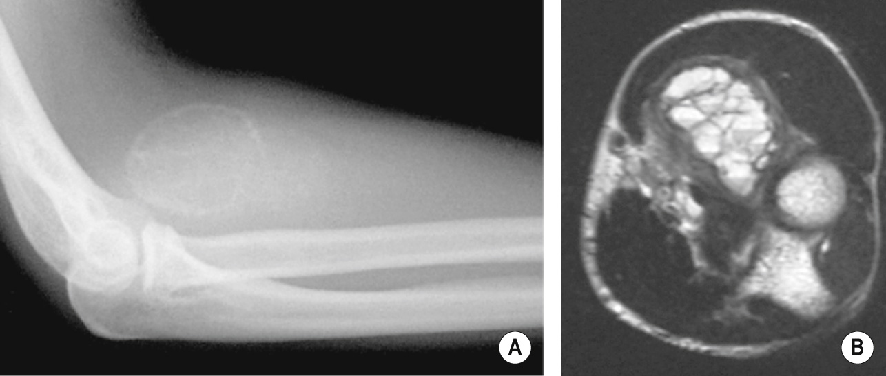 Antecubital myositis ossificans. (A) The plain XR shows the characteristic peripheral ossification and multiple high SI fluid levels (haemorrhage) on the axial MR image (B). †