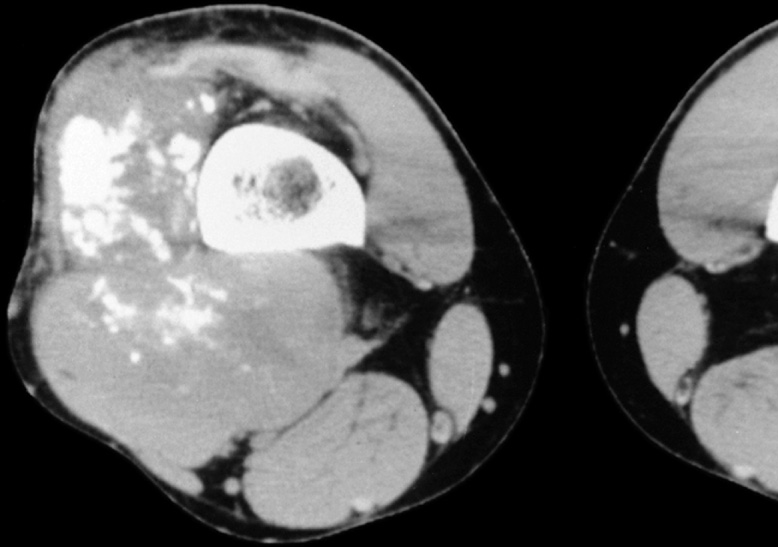 Synovial sarcoma. Axial CT demonstrating a soft tissue mass lateral and posterior to the femur containing calcifications. *