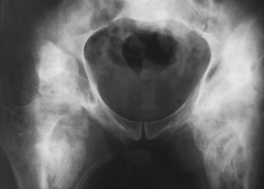 Myositis ossificans associated with paraplegia. Very extensive ossification is seen around both hips. †