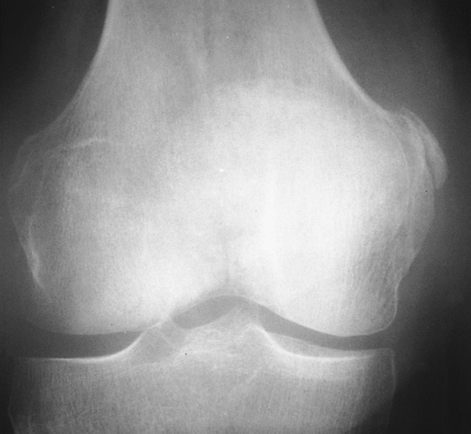 Pellegrini–Stieda lesion of the medial femoral condyle. †