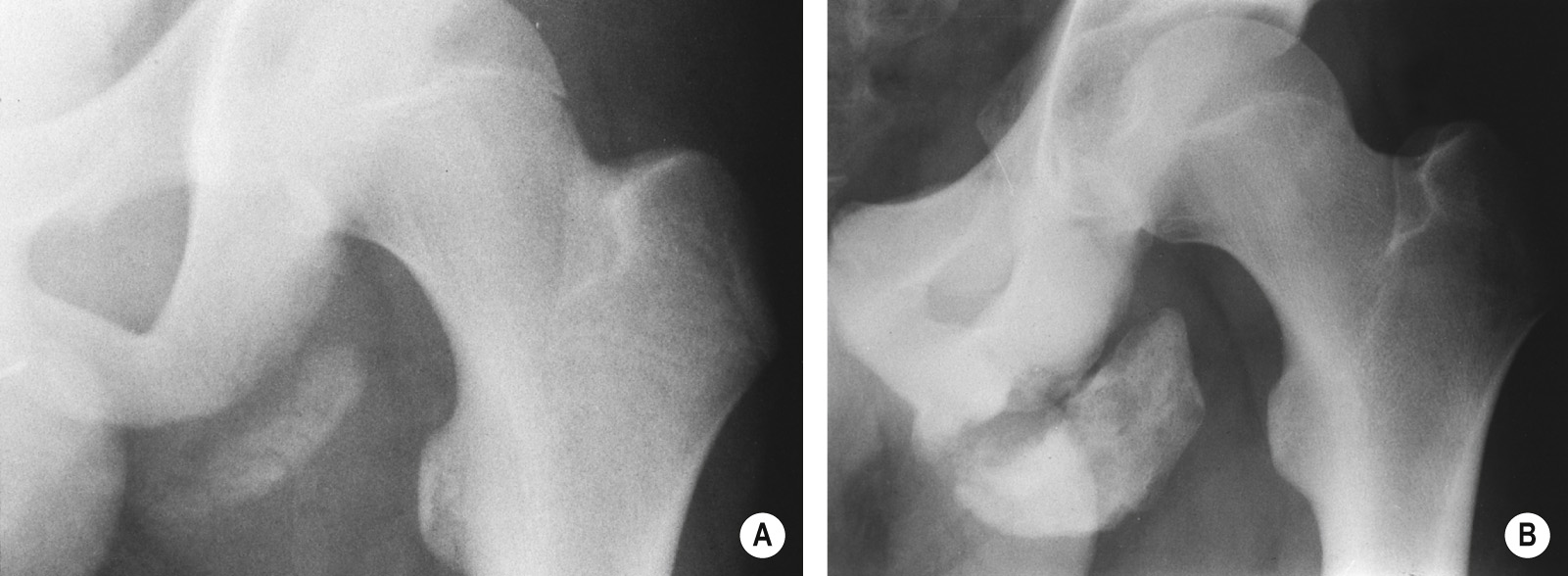 Ischial avulsion. (A) XR at presentation shows the avulsed ischial apophysis. (B) Three years later the apophysis has continued to grow to form a large ossified mass. *