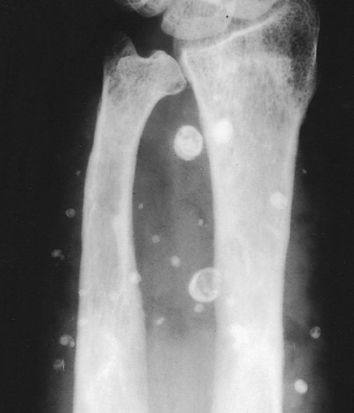 Cavernous haemangioma with multiple phleboliths. †