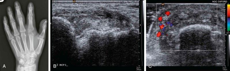 FIGURE 64–1, Septic arthritis of the metacarpophalangeal joint of the index finger is seen as rarefaction of bone on either side of the joint. A , There is narrowing of the joint space and marginal erosion. Unlike an inflammatory joint disease, this is a monoarthropathy isolated to one articulation. B , The infected joint imaged by ultrasound shows thickened and ill-defined joint margins and echogenic (bright) synovial proliferation. C , There is a markedly increased blood supply, as shown by Doppler ultrasound examination.
