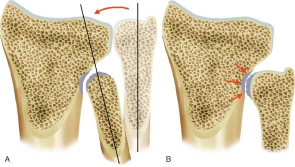 FIGURE 18–1, Cardinal features of ulnar impingement. A , Ulnar impingement syndrome secondary to distal ulnar resection: shortened ulna proximal to the sigmoid notch, scalloping of the distal radius, and radioulnar convergence (arrow) . B , Ulnar impingement secondary to significant ulnar-negative variance or premature fusion of the distal ulna. Note the scalloping of the distal radius proximal to the sigmoid notch (arrows) .