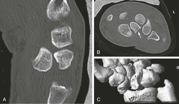 FIGURE 18–8, Lunate dislocation associated with transscaphoid fracture. Sagittal ( A ), axial ( B ), and reformatted 3D ( C ) CT images show volar lunate dislocation associated with transscaphoid fracture (arrow) .