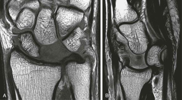 FIGURE 18–9, Traumatic volar lunate dislocation. Coronal ( A ) and sagittal ( B ) T1-weighted MR images show complete volar lunate dislocation (stage 4 perilunate instability) secondary to tear of the volar extrinsic radiocarpal ligaments and tear of the intrinsic scapholunate and lunotriquetral ligaments.