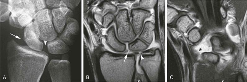 FIGURE 18–10, Traumatic ulnar translocation of the carpus. A , Conventional radiograph shows ulnar translocation of the carpus (arrow) and scapholunate interosseous widening (arrowhead) . B and C , Coronal T1-weighted MR arthrogram images reveal rupture of the scapholunate ligament (arrow) , tear of the central portion of the TFC (arrowhead) , and complete rupture of the radiolunotriquetral and the radioscapholunate ligaments (asterisk) .