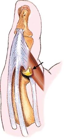 FIGURE 18–11, Illustration of a Stener lesion. Distal tear of the ulnar collateral ligament of the metacarpophalangeal joint of the thumb retracted and superficial to the adductor aponeurosis (arrow) .