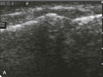 eFIGURE 18–4, Tear of the ulnar collateral ligament of the thumb. A , Ultrasound image reveals complete tear of the ulnar collateral ligament of the thumb metacarpophalangeal joint. B , Dynamic examination with slightly valgus stress of the joint shows radial deviation with joint space widening.