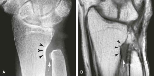 FIGURE 18–2, Ulnar impingement. Patient was referred for distal forearm pain after a Darrach procedure that was performed 6 years earlier. A , Posteroanterior radiograph shows extensive distal ulnar excision, focal remodeling, distal radius sclerosis (arrowheads) , and proliferative changes in the distal ulnar stump (arrow) . B , Coronal T1-weighted image reveals focal remodeling and sclerosis at the distal radius proximal to the sigmoid notch (arrowheads) . Note soft tissue thickening interposed between distal radius and ulnar stump (arrow) .