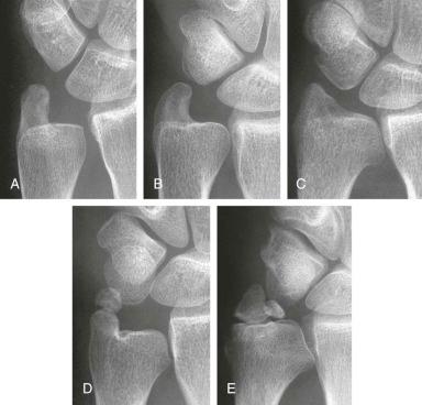 FIGURE 18–4, Anatomic variants and pathologic process related to the ulnar styloid impaction syndrome. Plain radiographs show elongated ulnar styloid ( A ); radially deviated ulnar styloid (parrot-beaked) ( B ); enlarged ulnar styloid ( C ); type 1 ulnar styloid nonunion (tip of the styloid process) ( D ); and type 2 ulnar styloid nonunion (base of the styloid process) ( E ).