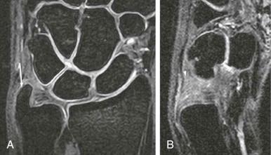 FIGURE 18–5, Ulnar styloid impaction syndrome. A , Coronal, fat-suppressed, T1-weighted MR image reveals an excessive long ulnar styloid process (arrow) . B , Sagittal, fat-suppressed, T1-weighted MR image shows chondromalacia on the dorsal aspect of triquetral bone and small subchondral cysts (arrowhead) .