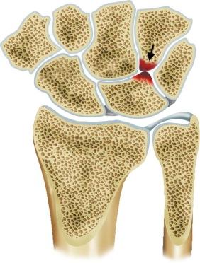 FIGURE 18–6, Illustration of hamatolunate impaction syndrome, Viegas type II lunate bone, chondromalacia of the proximal pole of the hamate bone, and secondary subchondral changes (arrow) .