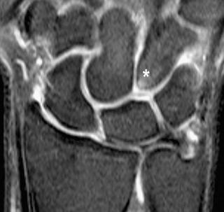 FIGURE 18–7, Hamatolunate impaction syndrome. Coronal, fat-suppressed, T2-weighted MR image shows type II lunate bone with advanced chondromalacia in the proximal pole of the hamate bone, secondary subchondral sclerosis, and bone marrow edema (asterisk) . The symptoms resolved completely after arthroscopic resection of the proximal pole of the hamate bone.