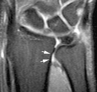 eFIGURE 18–1, Ulnar impingement. Coronal, fat-suppressed, T2-weighted MR image demonstrates negative ulnar variance and subtle radial remodeling (arrows).