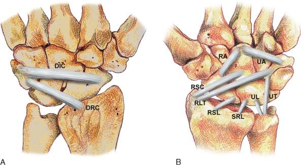 eFIGURE 18–2, Anatomy of the extrinsic ligaments. A and B , Diagrams illustrating the extrinsic radiocarpal and ulnocarpal ligaments. DIC, Dorsal intercarpal ligament; DRC, dorsal radiocarpal ligament; RA, radial arm of the deltoid ligament; RLT, radiolunotriquetral; RSC, radioscaphocapitate; RSL, radioscapholunate; SRL, short radiolunate ligaments; UA, ulnar arm of the deltoid ligament; UL, ulnolunate ligament; UT, ulnotriquetral ligament.