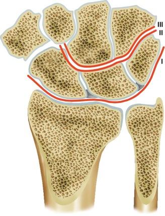 eFIGURE 18–3, Gilula's arcs. Posteroanterior view of a normal wrist. Three smooth arcs normally outline proximal and distal cortical margins of the proximal carpal row and proximal carpal surfaces of the hamate and capitate. Broken arc, loss of parallelism, and widening or overlapping of normally parallel joint spaces are strongly suggestive of ligamentous, bone, or joint injury and necessitate further evaluation.